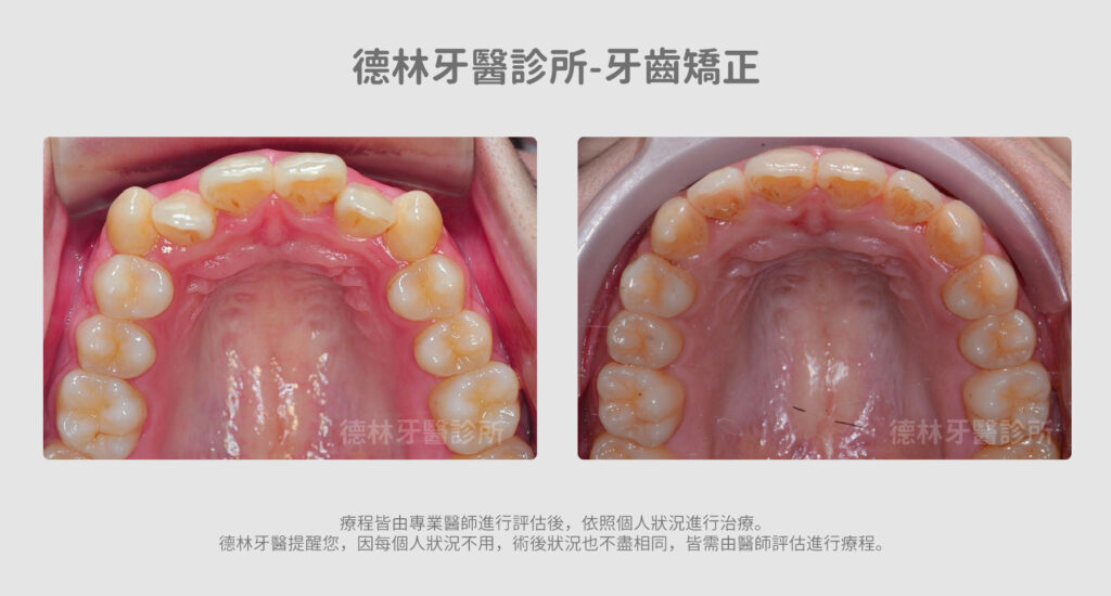 牙齒矯正案例 德林牙醫