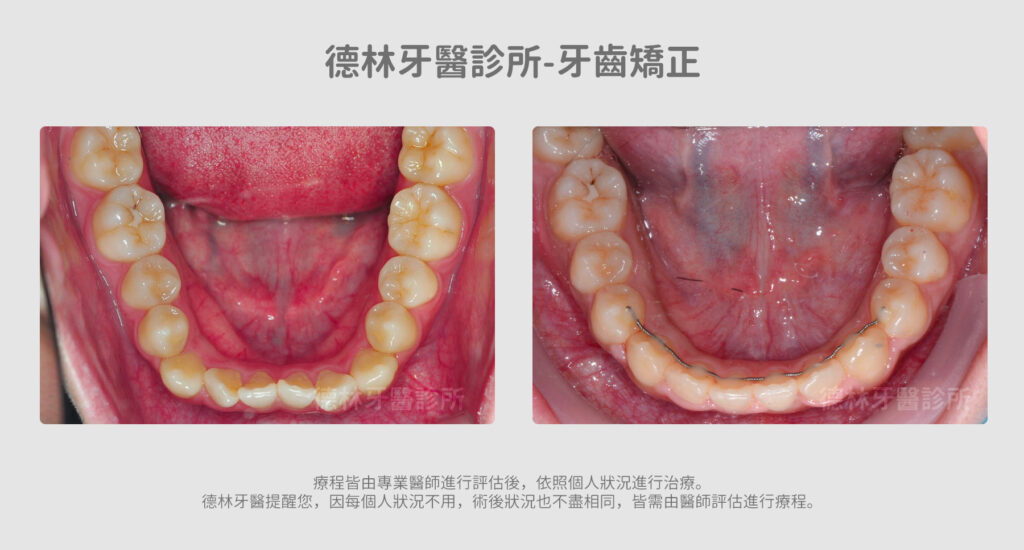 牙齒矯正案例 德林牙醫