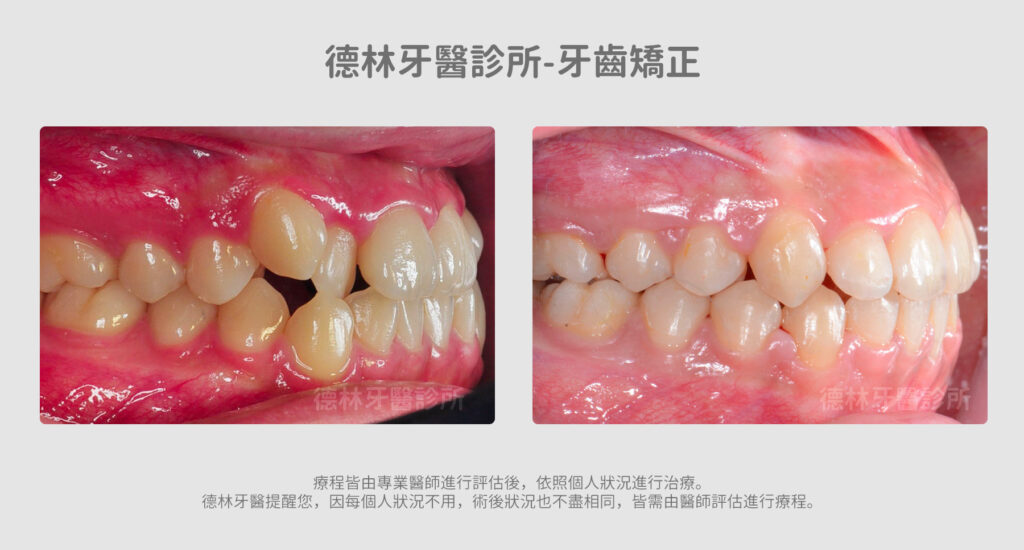 牙齒矯正案例 德林牙醫