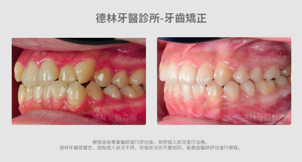 牙齒矯正案例 德林牙醫