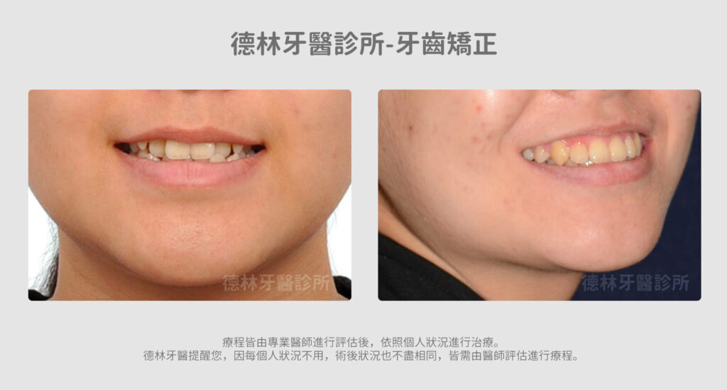牙齒矯正案例 德林牙醫